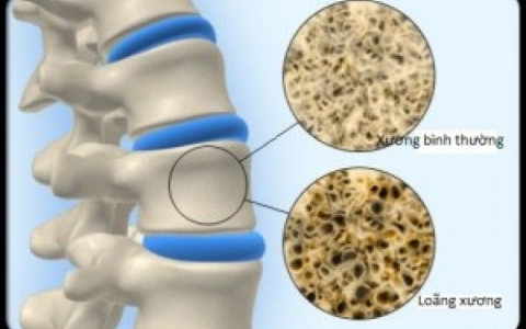 Những kẻ 'chủ mưu' g&acirc;y lo&atilde;ng xương