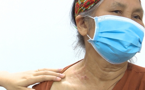 Bệnh Zona c&oacute; xu hướng tăng sau Covid-19