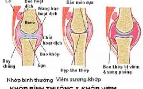 C&aacute;ch ph&ograve;ng đau nhức khớp trong m&ugrave;a lạnh
